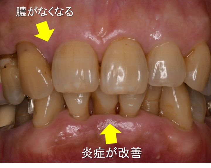 船堀（東京都江戸川区）の歯医者で予防歯科