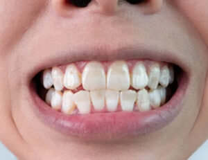 船堀（東京都江戸川区）の歯医者、ライフケアデンタルオフィスで歯の表面がザラザラする原因と滑らかにする方法を解説