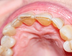 船堀（東京都江戸川区）の歯医者、ライフケアデンタルオフィスで歯の表面がザラザラする原因と滑らかにする方法を解説