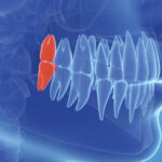 船堀（東京都江戸川区）の歯医者、ライフケアデンタルオフィスで親知らずを抜かない選択をした場合のリスクと管理方法を解説