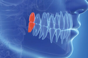 船堀（東京都江戸川区）の歯医者、ライフケアデンタルオフィスで親知らずを抜かない選択をした場合のリスクと管理方法を解説