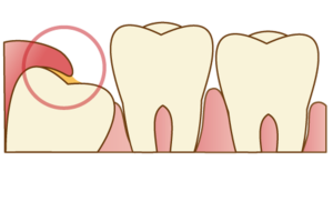 親知らずを抜かない選択をした場合のリスクと管理方法を解