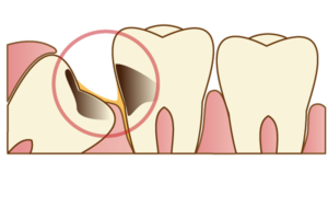 親知らずを抜かない選択をした場合のリスクと管理方法を解