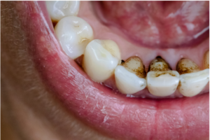 船堀（東京都江戸川区）の歯医者、ライフケアデンタルオフィスで歯の表面がザラザラする原因と滑らかにする方法を解説