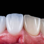 船堀（東京都江戸川区）の歯医者、ライフケアデンタルオフィスで歯が透けて見える原因とそのリスク、治療法を解説