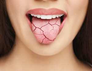 船堀の歯医者、ライフケアデンタルオフィスで、唾液が少ないとどんな問題が起こる？ドライマウスの影響と対策を解説