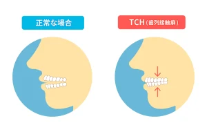 船堀の歯医者、ライフケアデンタルオフィスで、TCH（歯列接触癖）とは？無意識の食いしばりが引き起こす問題を解説